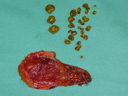 Aufgeschnittene Gallenblase mit Cholesterinsteinen