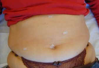 8 Tage nach der Operation